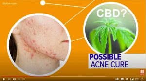 cbd oil for acne